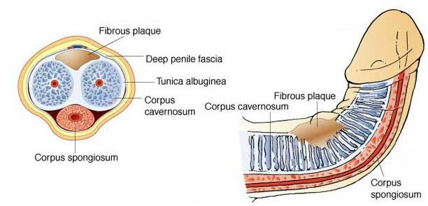 Peyronies (Bent Penis) Condition, How to Treat, Cure& Straighten