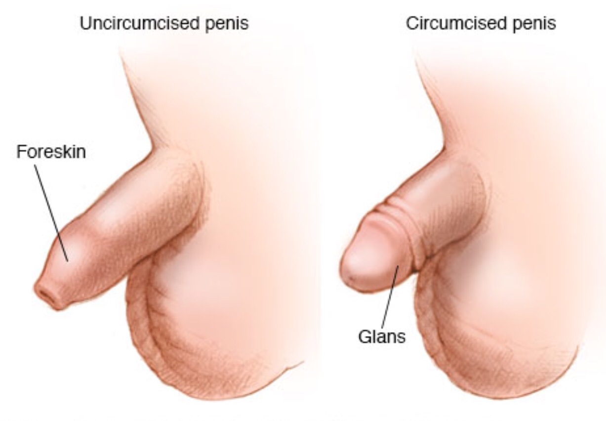 Circumcision and circumcision corrective surgery