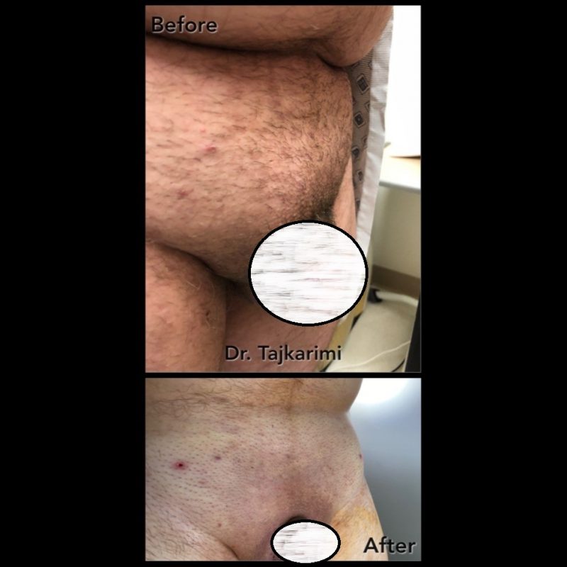 Scarless Office Monsplasty (liposuction & BodyTite) - Northern