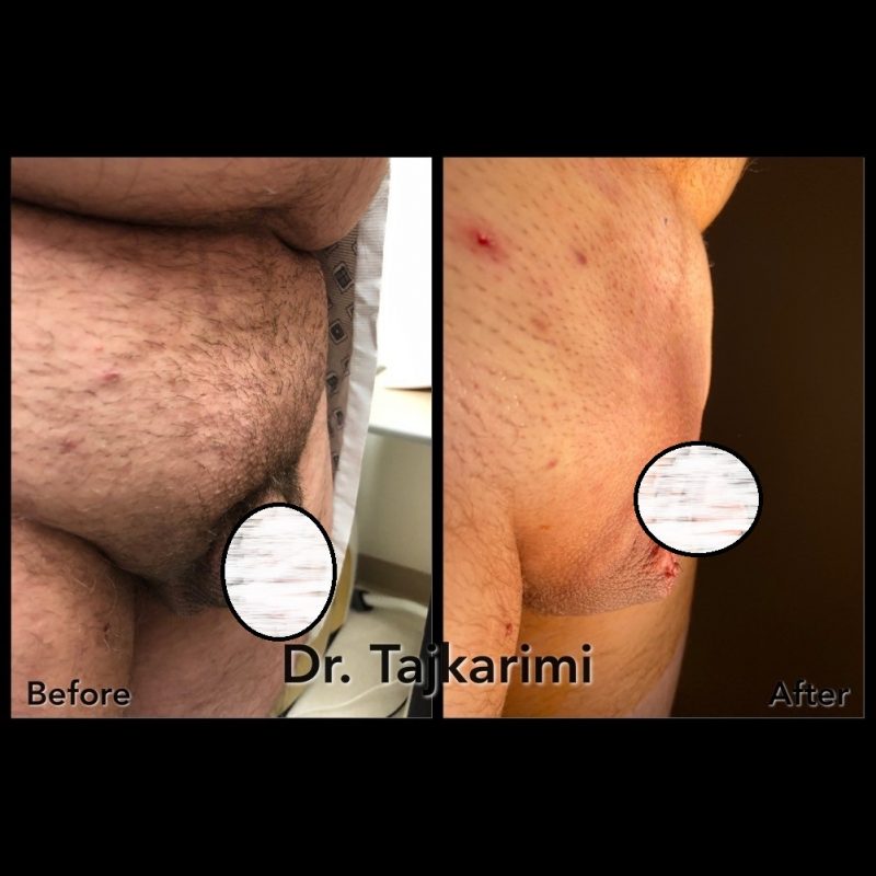 Scarless Office Monsplasty (liposuction & BodyTite) - Northern Virginia